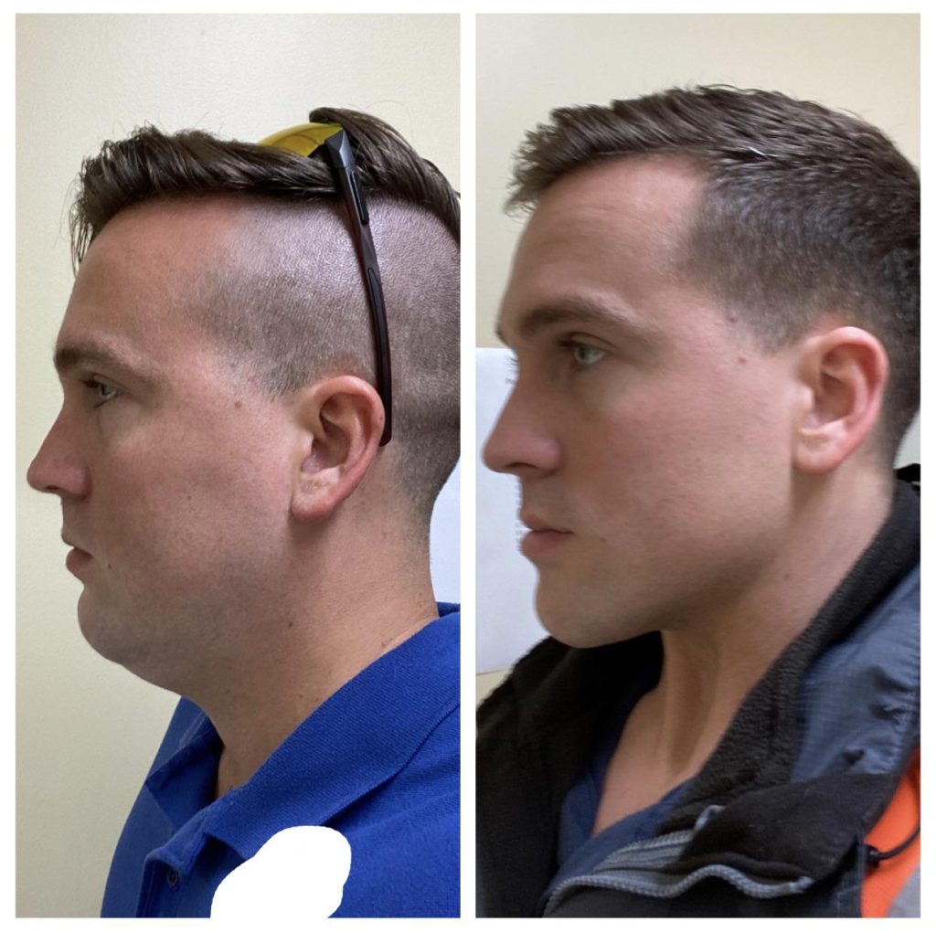 What Is Mewing? Transform Your Jawline Naturally Today!