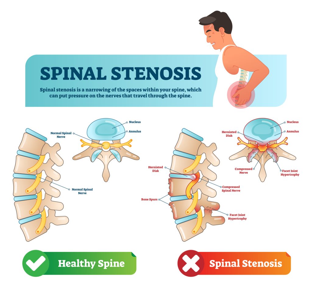 What Is The Newest Treatment For Spinal Stenosis?
